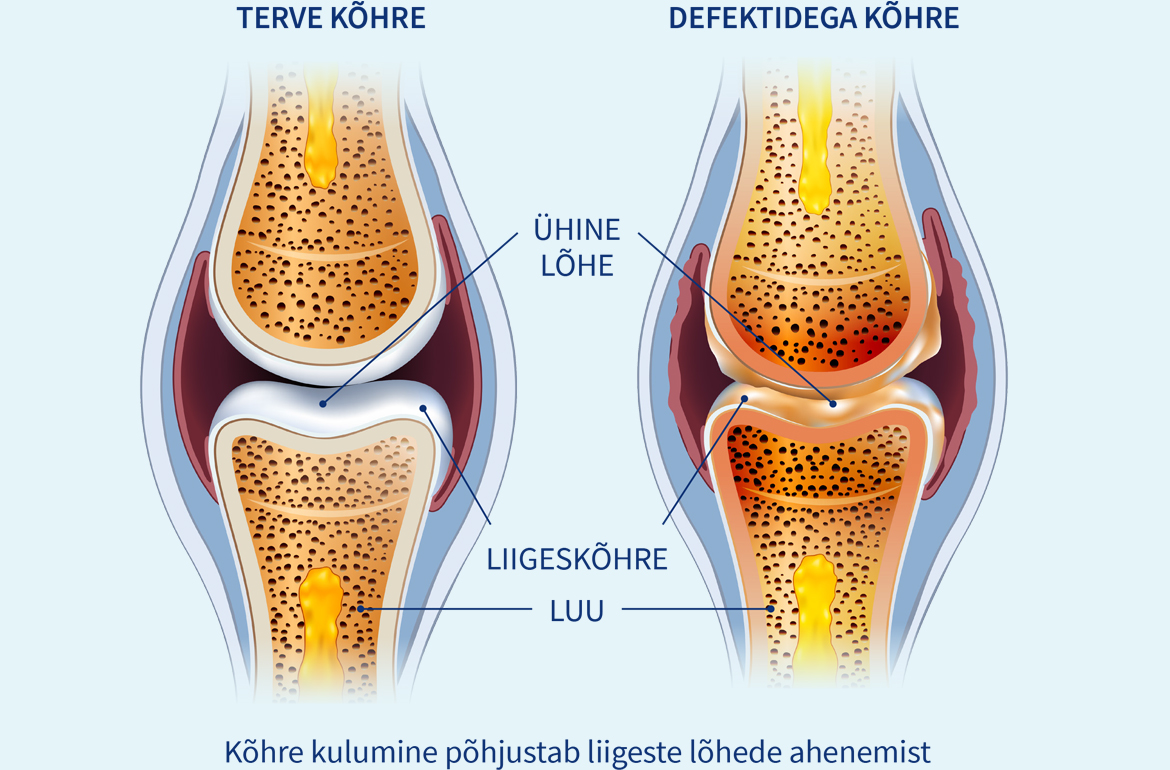 Natural Pharmaceuticals Fleximed® Active Vasakul terve liigese kõhre ja paremal defektidega kulunud liigeskõhre koos liigese lõhede võrrelusega.