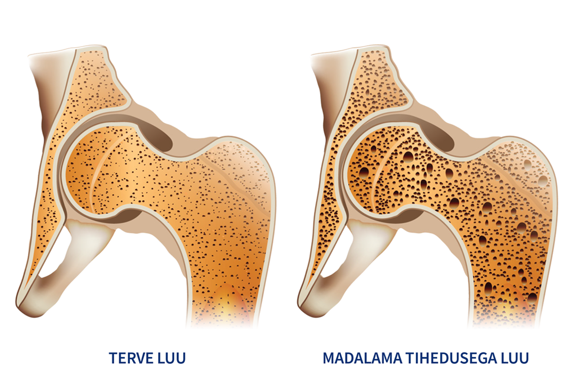 Natural Pharmaceuticals FlexiMed® Active Luu tervis ja osteoporoos: võrdlus terve luu ning madalama tihedusega luu struktuuri vahel.